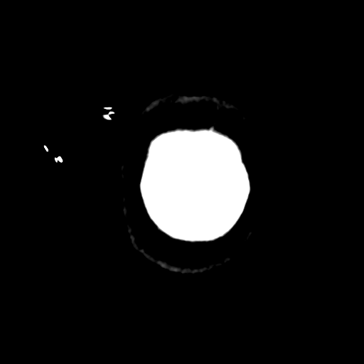 Cavernoma with hemorrhage (Radiopaedia 70755-80931 Coronal non-contrast 63).png