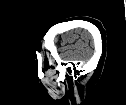 Cavernous hemangioma of the cerebellar falx (Radiopaedia 73025-83723 B 47).jpg