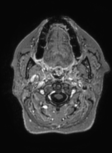 Cavernous hemangioma of the cerebellar falx (Radiopaedia 73025-83724 Axial T1 C+ 353).jpg