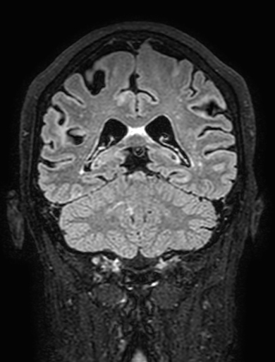 Cavernous hemangioma of the cerebellar falx (Radiopaedia 73025-83724 Coronal FLAIR 235).jpg