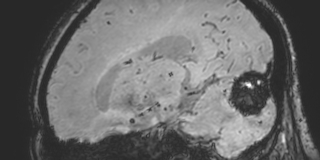 Cavernous hemangioma of the cerebellar falx (Radiopaedia 73025-83724 Sagittal BOLD 125).jpg