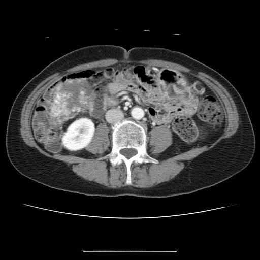 File:Cavernous hepatic hemangioma (Radiopaedia 75441-86667 B 64).jpg