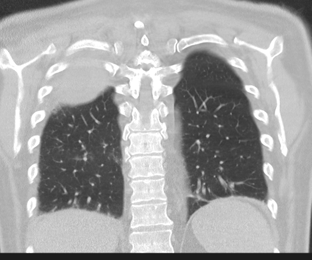 Cavitating pneumonia (Radiopaedia 45998-50329 Coronal lung window 38).png