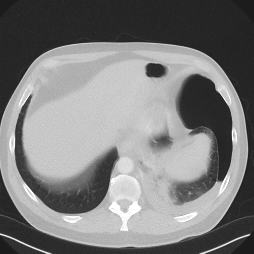 Cavitating pneumonia complicated by pneumothorax (Radiopaedia 48149-52994 Axial lung window 55).png