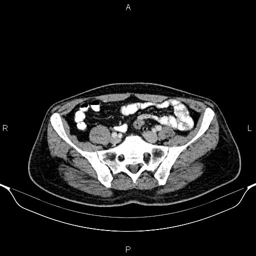 File:Cecal adenocarcinoma (Radiopaedia 85324-100916 B 72).jpg
