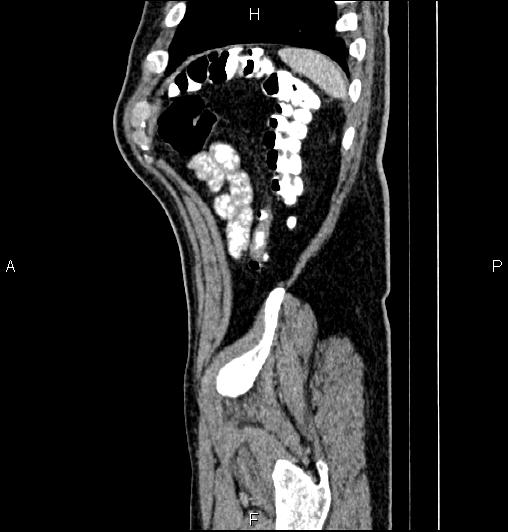Cecal adenocarcinoma (Radiopaedia 85324-100916 E 83).jpg