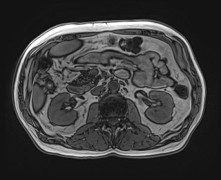 Cecal mass causing appendicitis (Radiopaedia 59207-66532 D 60).jpg