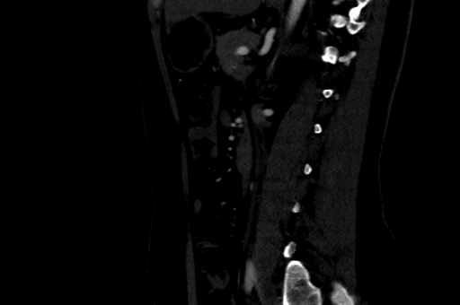 Celiac artery compression syndrome (Radiopaedia 47538-52152 B 66).jpg