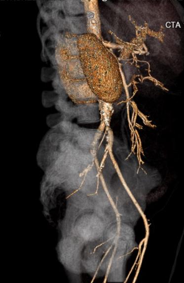 File:Celiac artery severe stenosis and dissection (Radiopaedia 44128-47842 C+ arterial phase 9).jpg