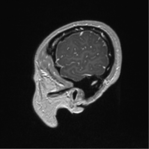 File:Central neurocytoma (Radiopaedia 37664-39557 Sagittal T1 C+ 14).png