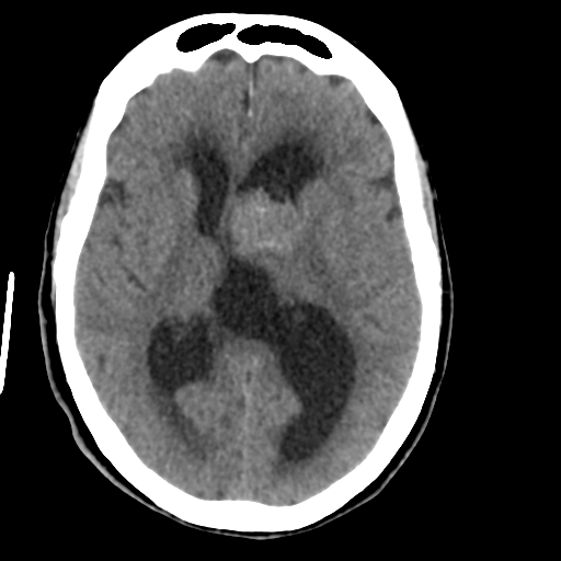 Central neurocytoma (Radiopaedia 65317-74346 Axial non-contrast 26).png