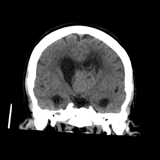 File:Central neurocytoma (Radiopaedia 65317-74346 Coronal non-contrast 28).png