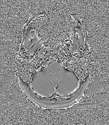 Central neurocytoma (Radiopaedia 84497-99872 Axial 9).jpg