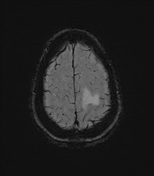 File:Central neurocytoma (Radiopaedia 84497-99872 Axial SWI 61).jpg