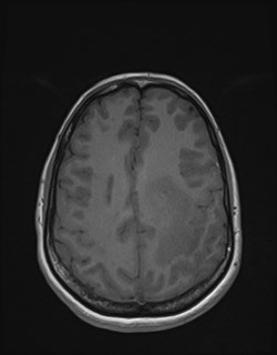 Central neurocytoma (Radiopaedia 84497-99872 Axial T1 141).jpg