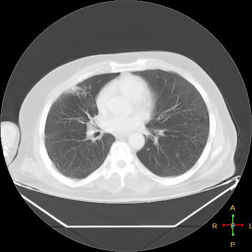 File:Centrilobular emphysema - with superimposed infection (Radiopaedia 24389-24683 lung window 16).jpg