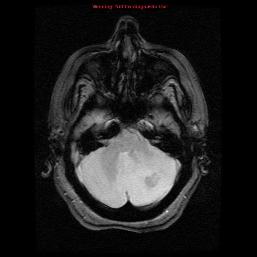 File:Cerebellar abscess (Radiopaedia 10845-11275 Axial Gradient Echo 1).jpg