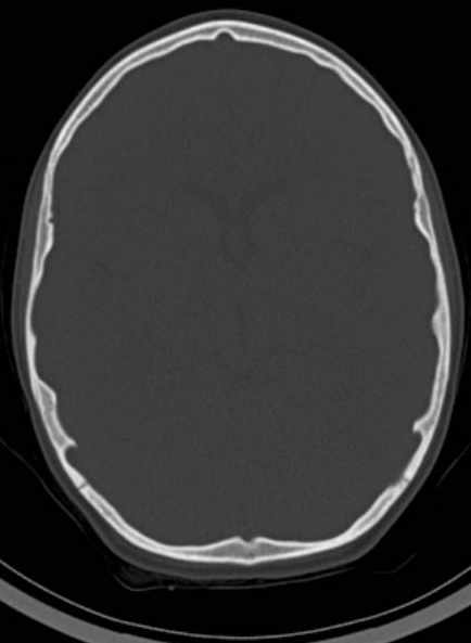 Cerebellar abscess (Radiopaedia 73727-84527 Axial bone window 36).jpg