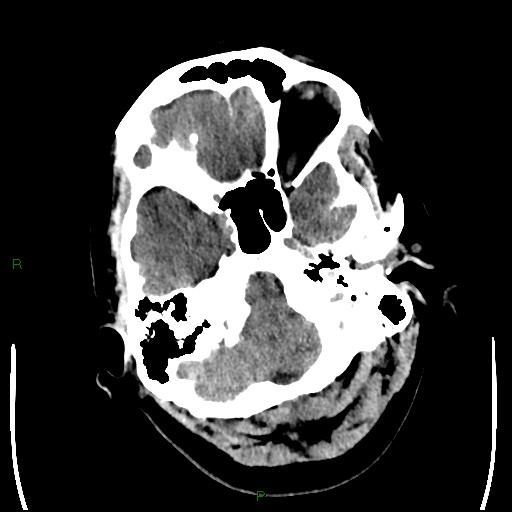 Cerebellar abscess (Radiopaedia 78135-90671 Axial non-contrast 22).jpg