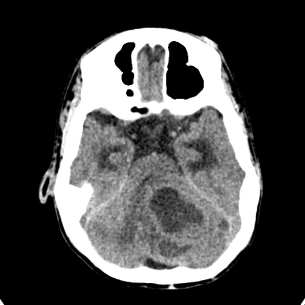 Cerebellar abscess secondary to mastoiditis (Radiopaedia 26284-26412 Axial non-contrast 49).jpg