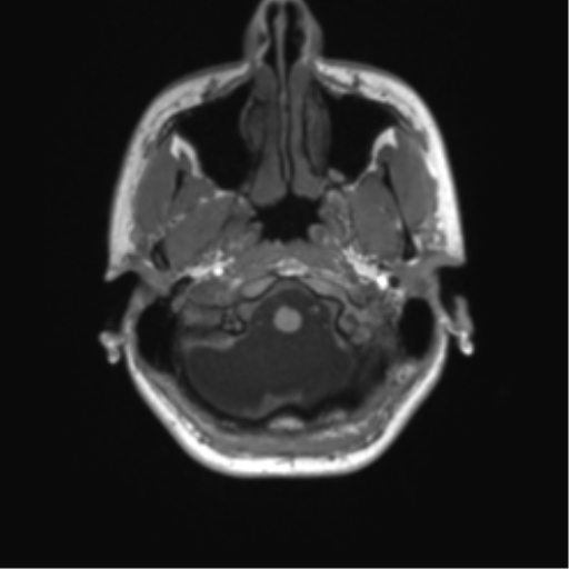 File:Cerebellar agenesis with hypoplastic pons (pontocerebellar hypoplasia) (Radiopaedia 57224-64138 Axial T1 12).png