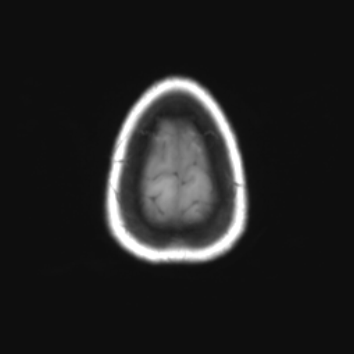 File:Cerebellar ependymoma complicated by post-operative subdural hematoma (Radiopaedia 83322-97736 Axial T1 37).png