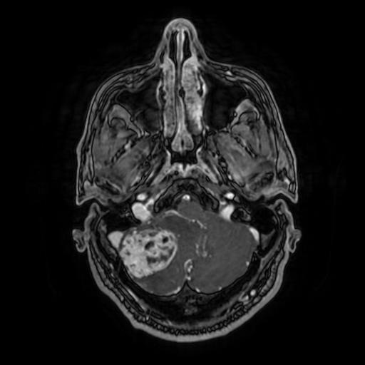 Cerebellar hemangioblastoma (Radiopaedia 88055-104622 Axial T1 C+ 44).jpg