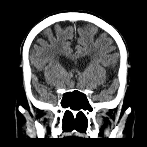 Cerebellar hemorrhage (Radiopaedia 27193-27359 Coronal non-contrast 22).jpg
