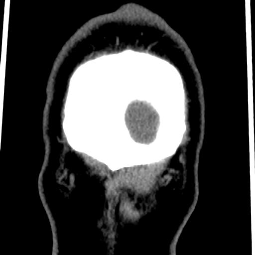 File:Cerebellar infarction (Radiopaedia 16625-16327 Coronal non-contrast 50).jpg