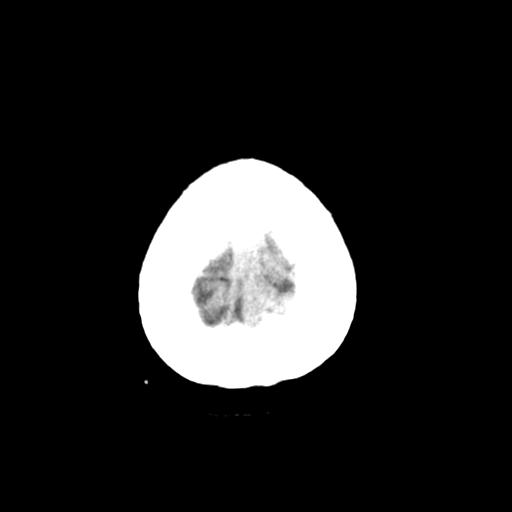 Cerebellar metastasis (Radiopaedia 54578-60812 Axial non-contrast 47).png
