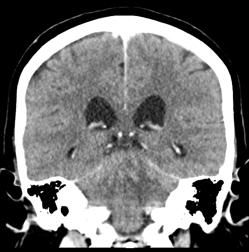 Cerebellar metastasis (Radiopaedia 54578-60812 Coronal C+ 37).png