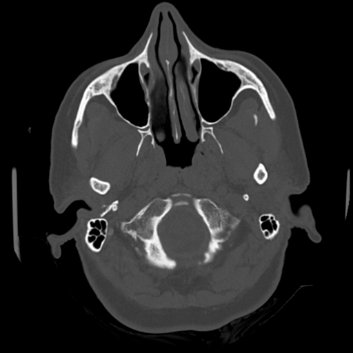 Cerebellar metastasis (cystic appearance) (Radiopaedia 41395-44258 Axial bone window 4).png