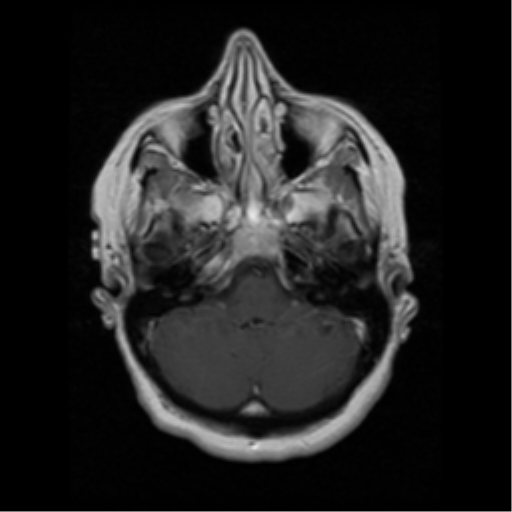 File:Cerebellar metastasis (cystic appearance) (Radiopaedia 41395-44262 Axial T1 C+ 4).png