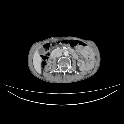 File:Cerebellar metastasis - lung tumor (Radiopaedia 69317-79150 A 45).jpg