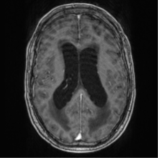 Cerebellar metastasis from lung adenocarcinoma (Radiopaedia 86690-102829 Axial T1 C+ 48).png