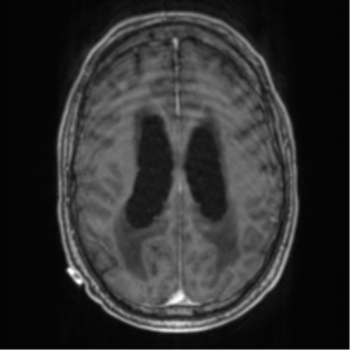 Cerebellar metastasis from lung adenocarcinoma (Radiopaedia 86690-102829 Axial T1 C+ 53).png