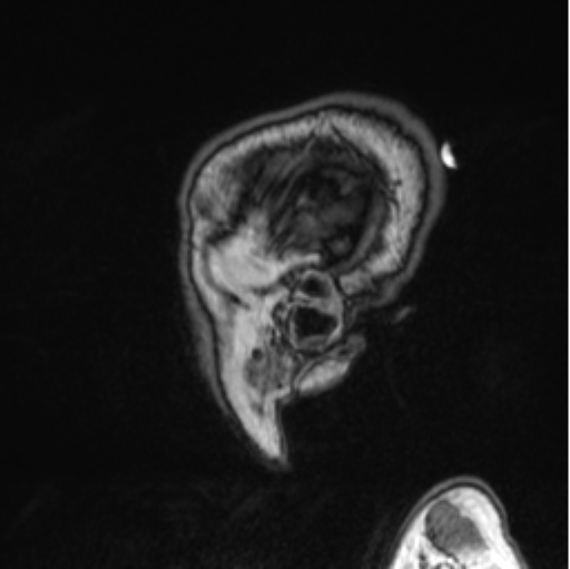 Cerebellar metastasis from lung adenocarcinoma (Radiopaedia 86690-102829 Sagittal T1 86).png