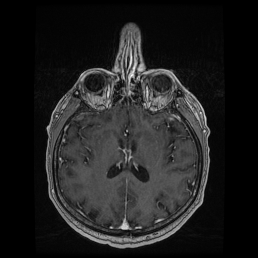 Cerebellar metastasis of pulmonary adenocarcinoma, cavernous venous malformation, and developmental venous anomaly (Radiopaedia 85827-101661 Axial T1 C+ 57).jpg