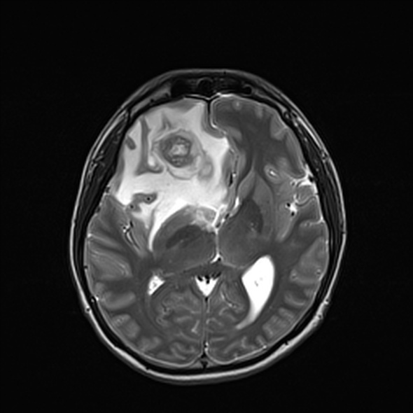 Cerebral abscess (Radiopaedia 24212-24478 Axial T2 32).jpg