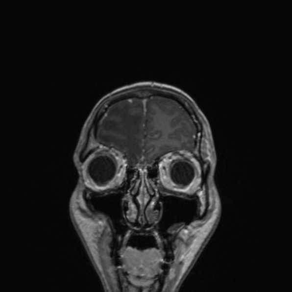 Cerebral abscess (Radiopaedia 24212-24478 Coronal T1 C+ 44).jpg
