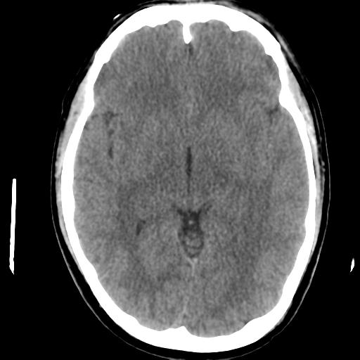 Cerebral abscess (Radiopaedia 29451-29919 Axial non-contrast 23).jpg