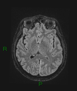 Cerebral abscess and subdural empyema (Radiopaedia 84436-99779 Axial FLAIR 42).jpg