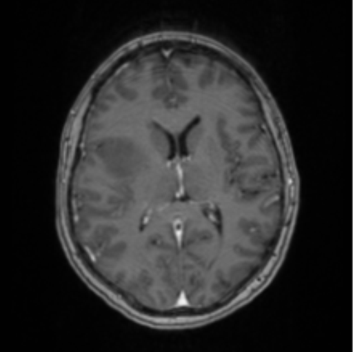 Cerebral abscess from pulmonary arteriovenous malformation (Radiopaedia 86275-102291 Axial T1 C+ 43).png