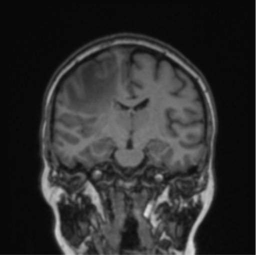 Cerebral abscess from pulmonary arteriovenous malformation (Radiopaedia 86275-102291 Coronal T1 47).png
