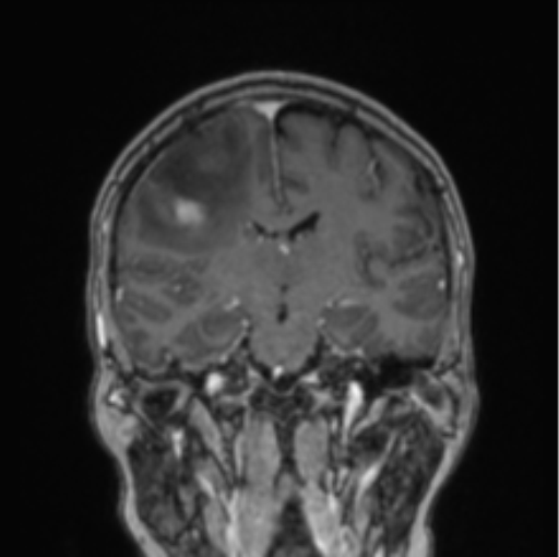 Cerebral abscess from pulmonary arteriovenous malformation (Radiopaedia 86275-102291 L 46).png