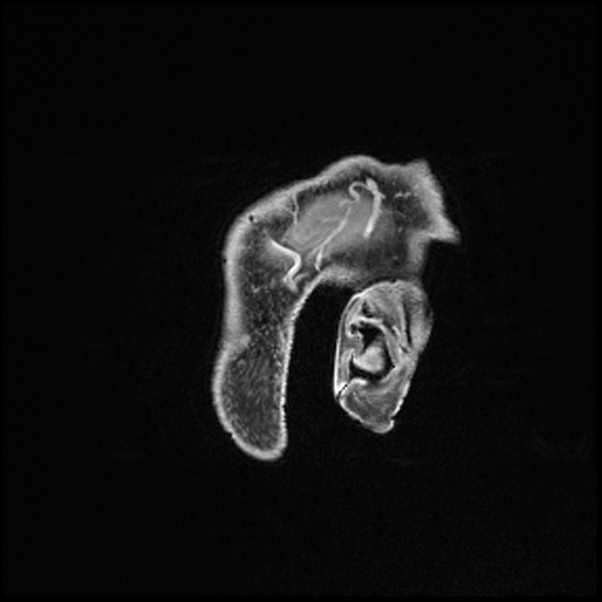 Cerebral abscess with ventriculitis (Radiopaedia 78965-91878 Sagittal T1 C+ 8).jpg