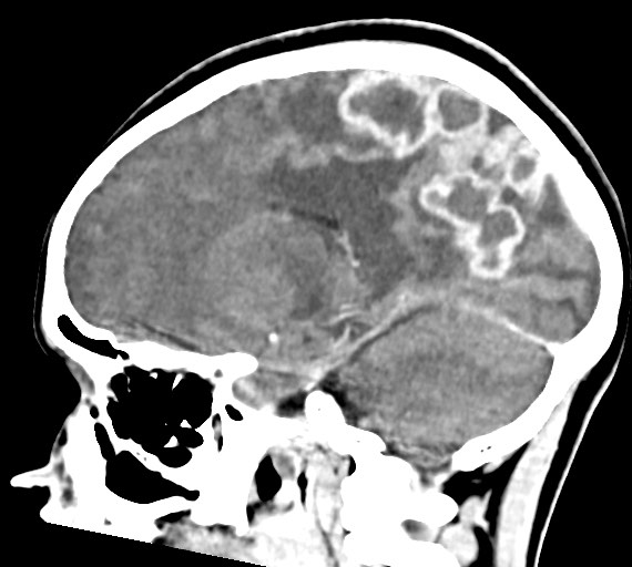 Cerebral abscesses (Radiopaedia 70458-80568 Sagittal Contrast 25).jpg