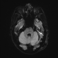 Cerebral amyloid angiopathy-related inflammation (Radiopaedia 74836-85849 Axial DWI 39).jpg