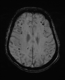 Cerebral amyloid angiopathy-related inflammation (Radiopaedia 74836-85849 Axial SWI 48).jpg