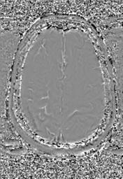 File:Cerebral amyloid angiopathy (Radiopaedia 29129-29518 Axial SWI Phase 29).jpg